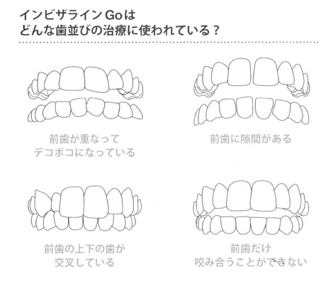 インビザラインGo